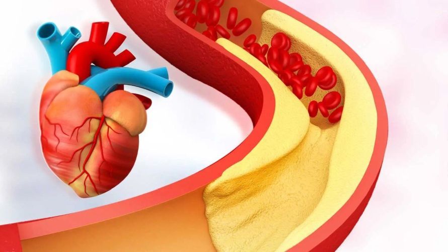 Почему повышен холестерин у женщин и у мужчин